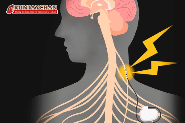 Giảm nguy cơ mắc bệnh Parkinson nhờ cắt dây thần kinh phế vị
